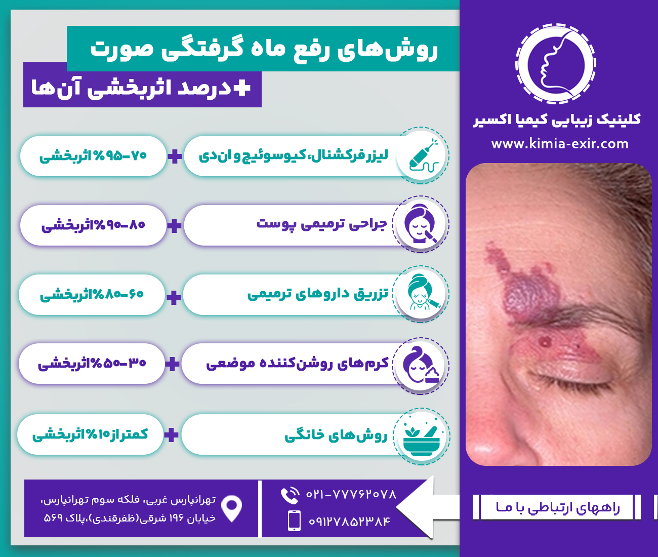 تایم‌لاین رفع ماه‌گرفتگی پس از لیزر
بلافاصله بعد از لیزر	قرمزی، تورم و احساس گرما
48 ساعت پس از لیزر	تورم خفیف یا کبودی موقت (شبیه آفتاب‌سوختگی)
1 الی 2 هفته پس از لیزر	کاهش التهاب و ظاهر کبود
3 تا 8 هفته بعد از لیزر	کم‌رنگ‌تر شدن ماه‌گرفتگی
4 الی 6 ماه پس از لیزر (بعد از جلسه دوم لیزر)	بهبود چشم‌گیر ماه‌گرفتگی
6 ماه الی 2 سال پس از لیزر (بعد از چند جلسه لیزر)	رفع کامل ماه‌گرفتگی و یکدست شدن رنگ پوست

