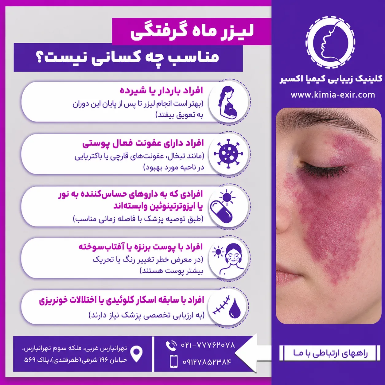 لیزر ماه گرفتگی