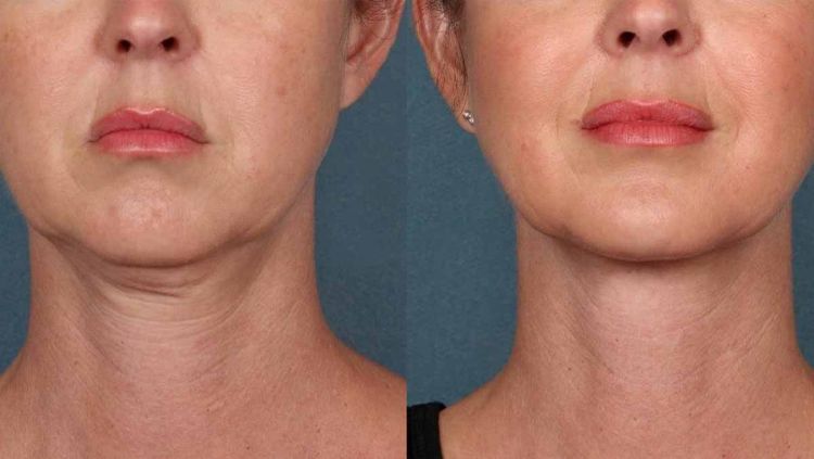 تعداد جلسات هایفوتراپی صورت.