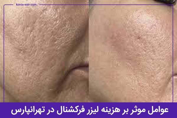 عوامل موثر بر هزینه لیزر CO2 فرکشنال در تهرانپارس