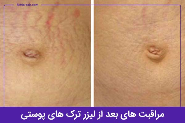 بعد از لیزر ترک‌های پوستی چه مراقبت هایی باید رعایت کنید؟
