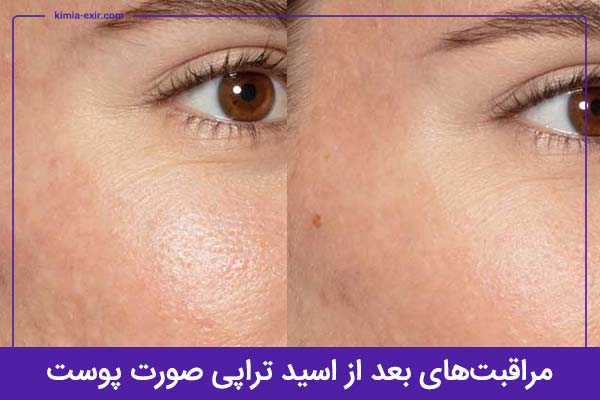 مراقبت‌های بعد از اسید تراپی صورت پوست چیست؟