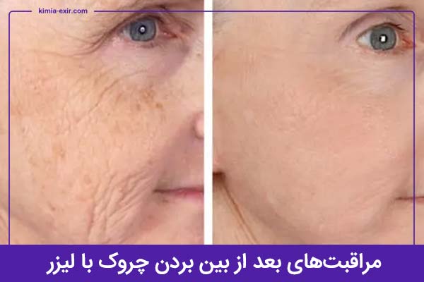 بعد از از بین بردن چروک با لیزر چه نکاتی را باید رعایت کنید؟