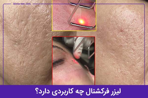 کاربرد های لیزر فرکشنال CO2