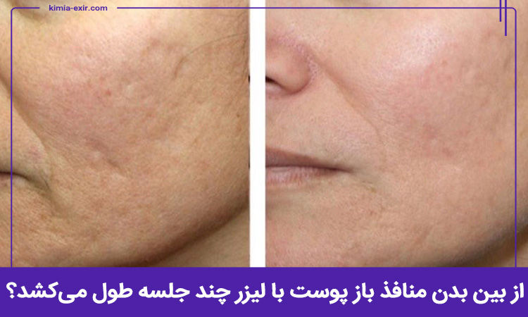 از بین بدن منافذ باز پوست با لیزر چند جلسه طول می‌کشد؟