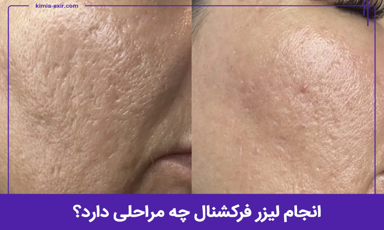 مراحل انجام لیزر فرکشنال CO2 در تهران به چه صورت است؟ 