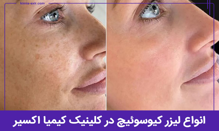 انواع خدمات لیزر کیوسوئیچ در کلینیک کیمیا اکسیر در تهرانپارس
