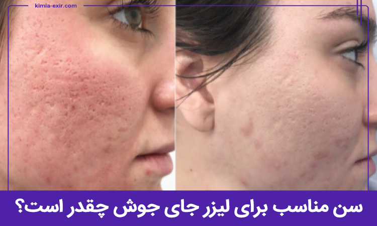بهترین سن برای لیزر جای جوش