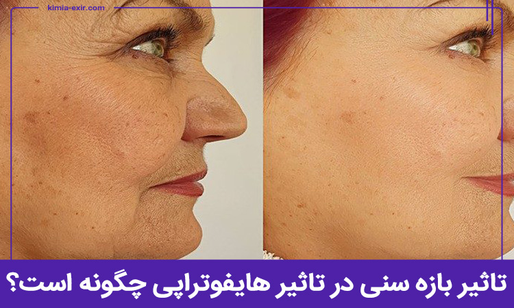 تاثیر بازه سنی در تاثیرگذاری هایفوتراپی چگونه است؟