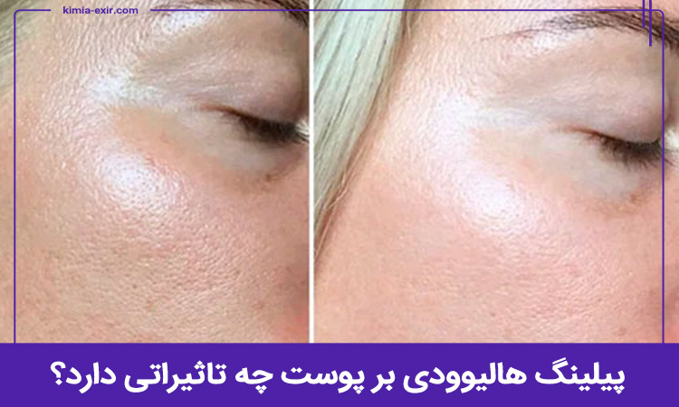 پیلینگ هالیوودی چه تاثیری بر پوست دارد؟ 