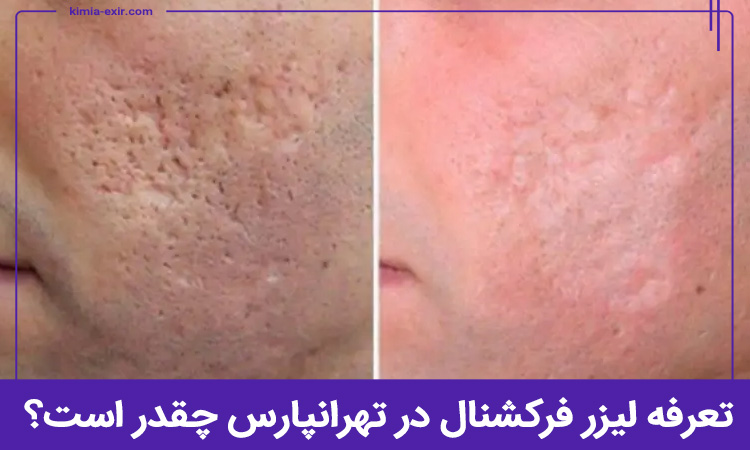 تعرفه لیزر CO2 فرکشنال در تهرانپارس چقدر است؟