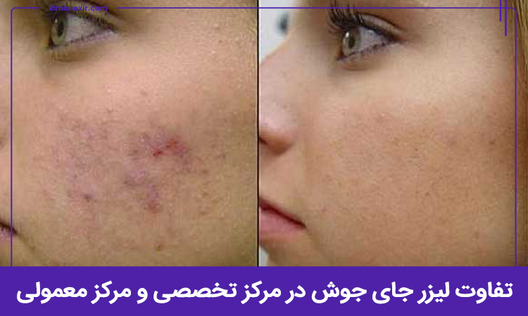 تفاوت لیزر جای جوش در مرکز تخصصی و مرکز معمولی