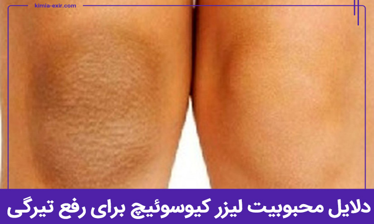 دلایل محبوبیت لیزر کیوسوئیچ برای رفع تیرگی چیست؟