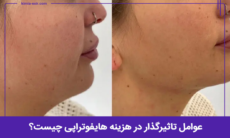 فاکتورهای تاثیرگذار در هزینه هایفوتراپی چیست؟