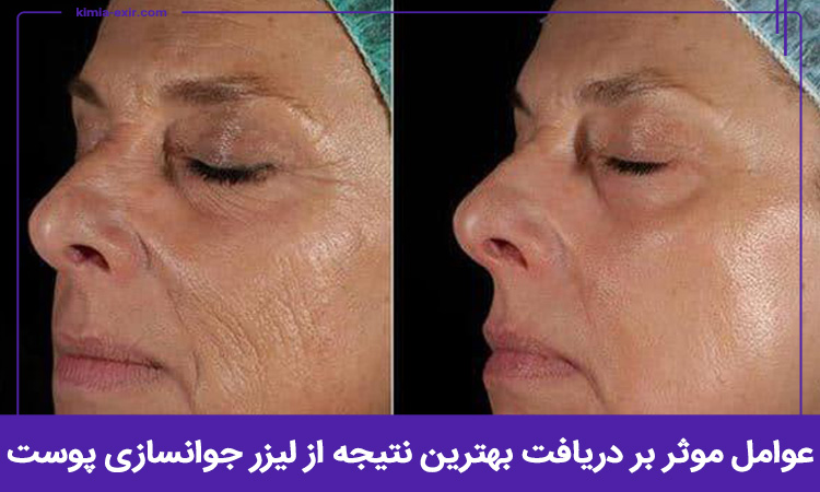 چگونه از لیزر جوانسازی پوست نتیجه بهتری بگیریم؟