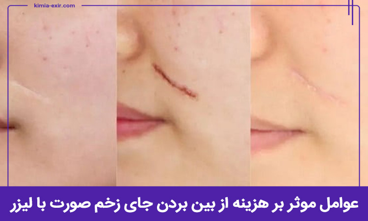 هزینه لیزر برای از بین بردن جای زخم به چه عواملی بستگی دارد؟