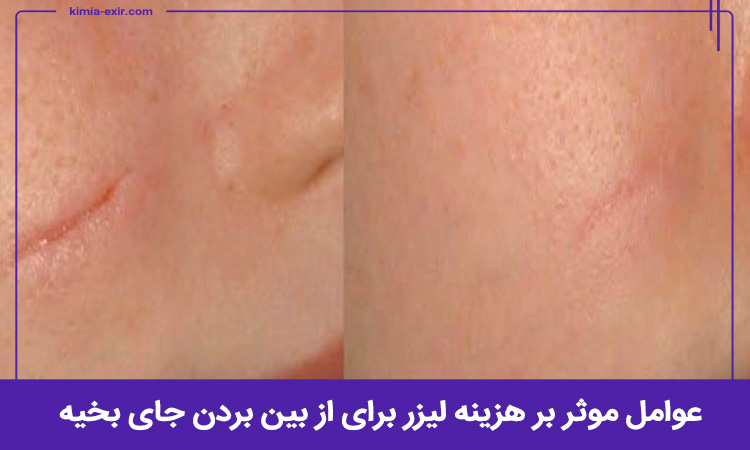 هزینه لیزر برای از بین بردن جای بخیه به چه عواملی بستگی دارد؟