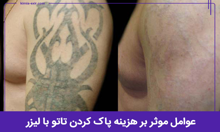 هزینه پاک کردن تاتو با لیزر به چه عواملی بستگی دارد؟