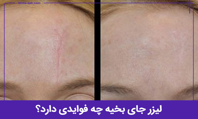 مزایا لیزر جای بخیه چیست؟