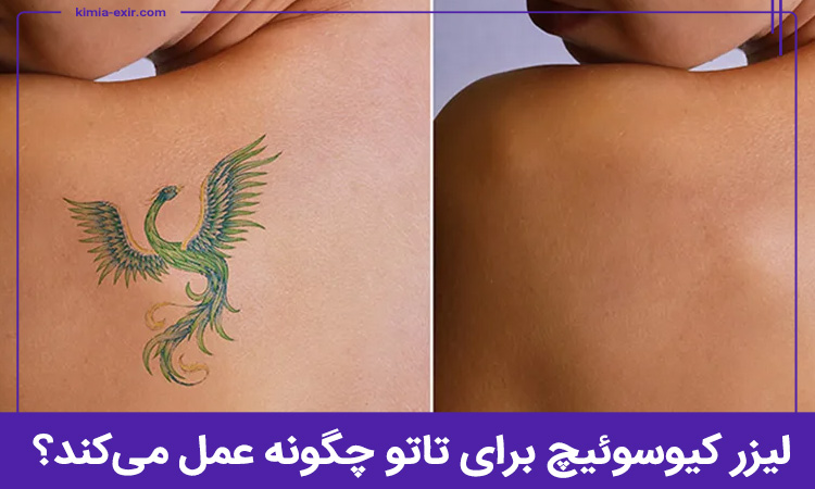 لیزر کیوسوئیچ برای تاتو چگونه عمل می‌کند؟