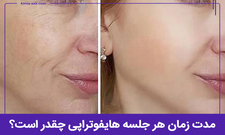 مدت زمان هر جلسه هایفوتراپی در شرق تهران