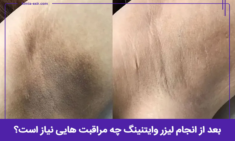 بعد از انجام لیزر وایتنینگ چه نکاتی را باید رعایت کنید؟