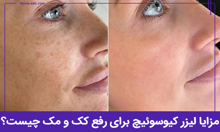 مزایا لیزر کیوسوئیچ برای رفع کک و مک