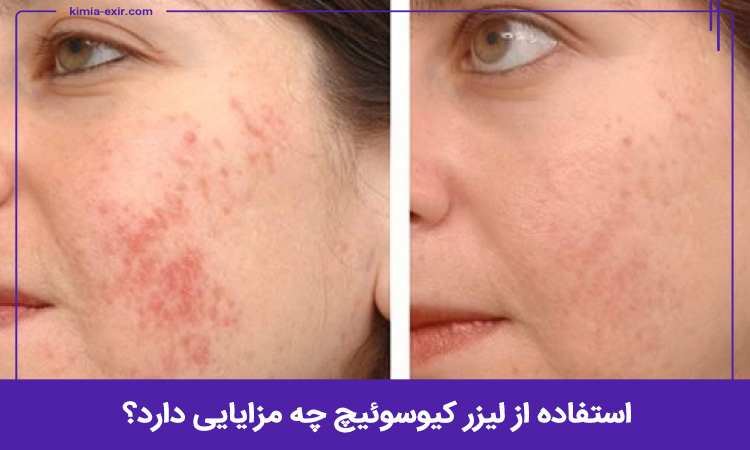 مزایای استفاده از لیزر کیوسوئیچ
