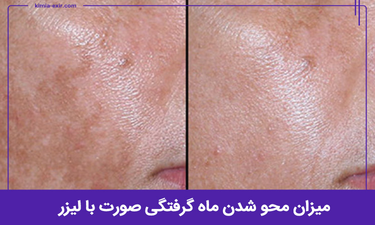 میزان محو شدن ماه گرفتگی صورت با لیزر