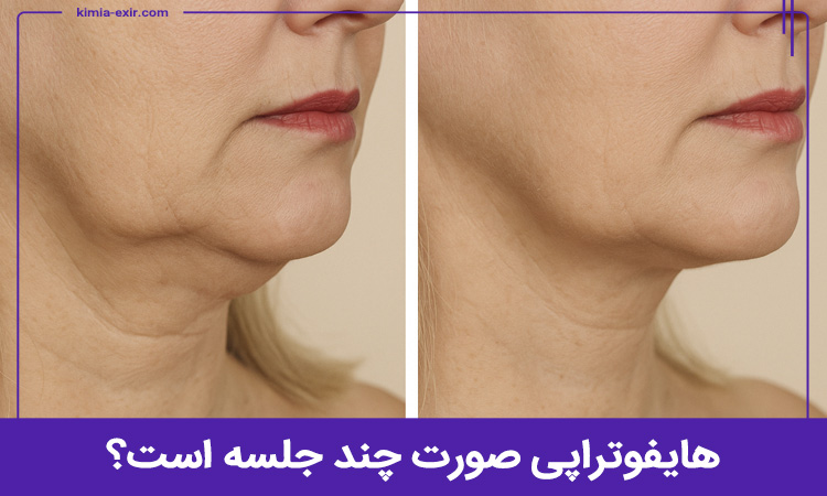 هایفوتراپی در چند جلسه انجام می‌شود؟