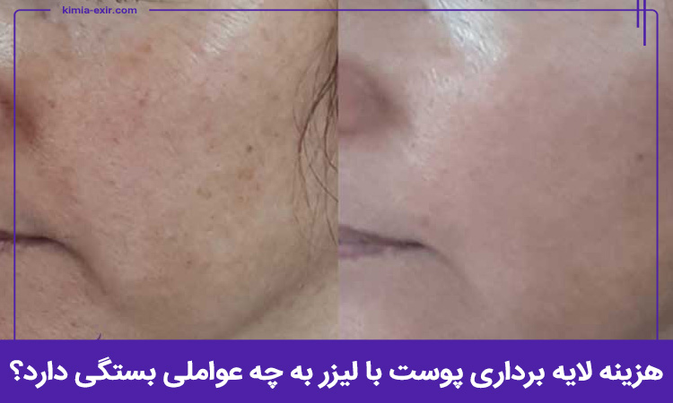 هزینه لایه برداری پوست با لیزر به چه عواملی بستگی دارد؟
