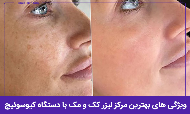 ویژگی بهترین مرکز لیزر کک و مک با دستگاه کیوسوئیچ در تهران