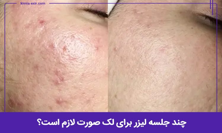چند جلسه لیزر برای لک صورت لازم است؟