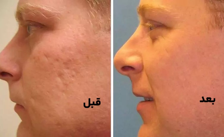 کربوکسی تراپی