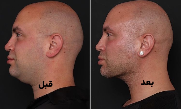 روش محبوب بوکال فت
