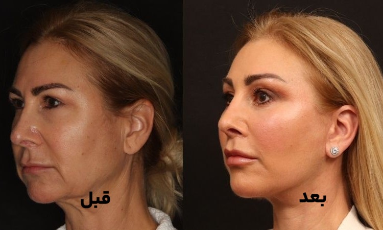 بوکال چربی