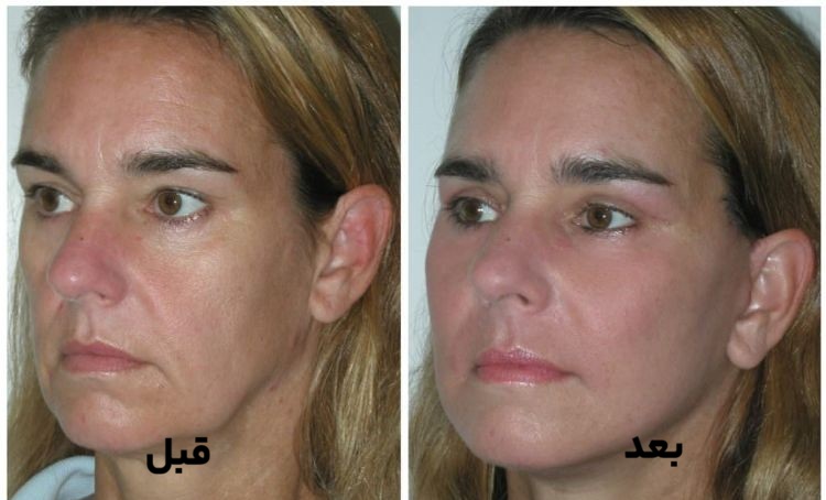کربوکسی تراپی صورت