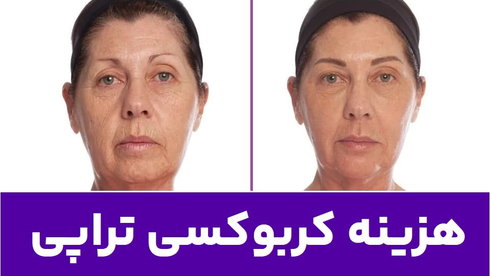 هزینه کربوکسی تراپی