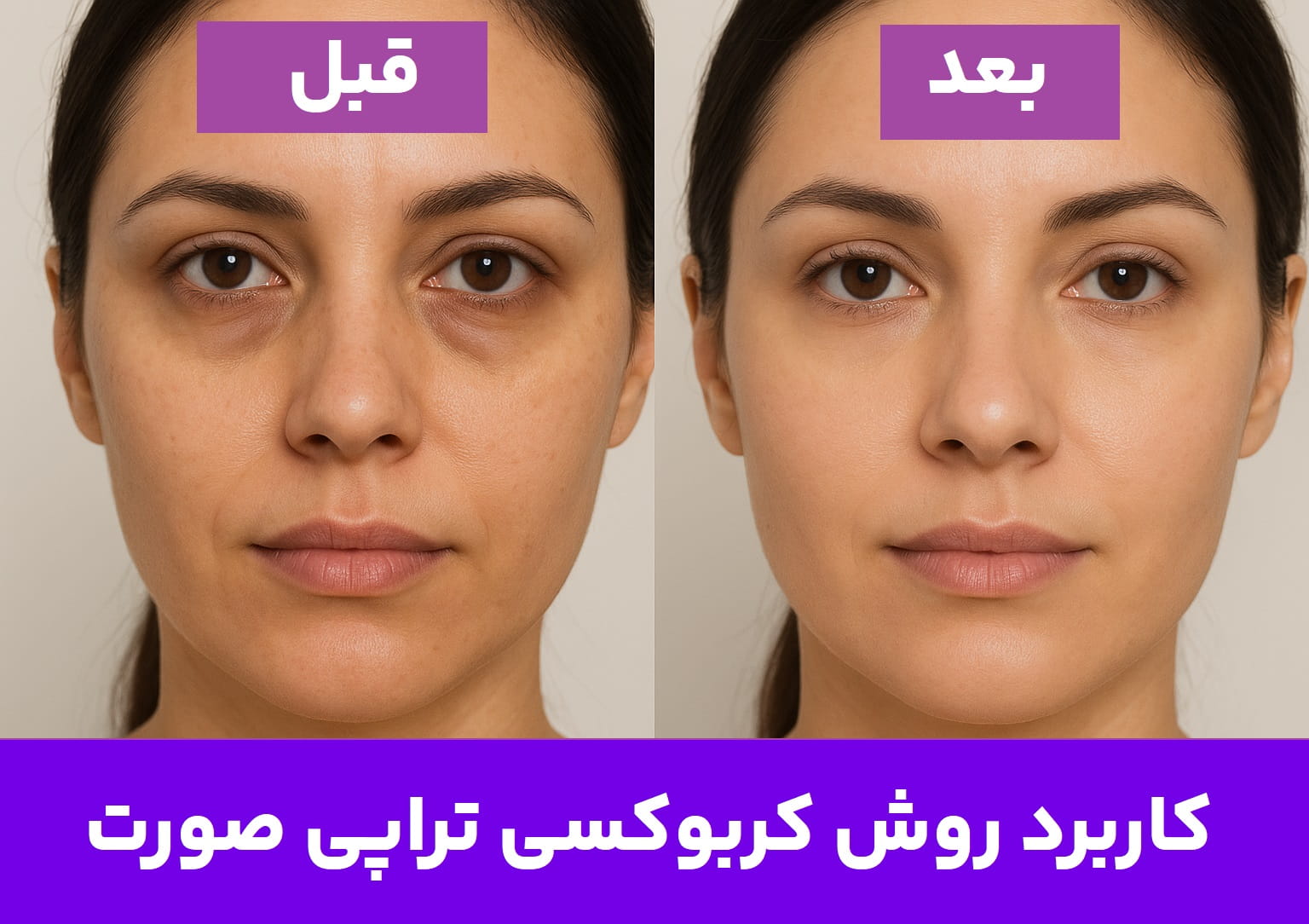 کربوکسی تراپی زیر چشم