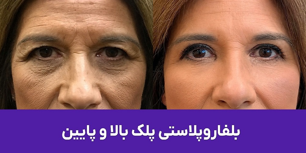 هزینه بلفاروپلاستی پلک بالا جهت رفع افتادگی پلک و جوانسازی چشم در کیمیا اکسیر