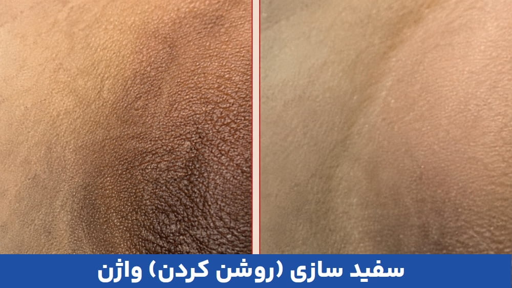 هزینه سفیدسازی واژن در تهران جهت بهبود یکنواختی رنگ پوست و افزایش اعتماد به نفس پرداخت میشود.