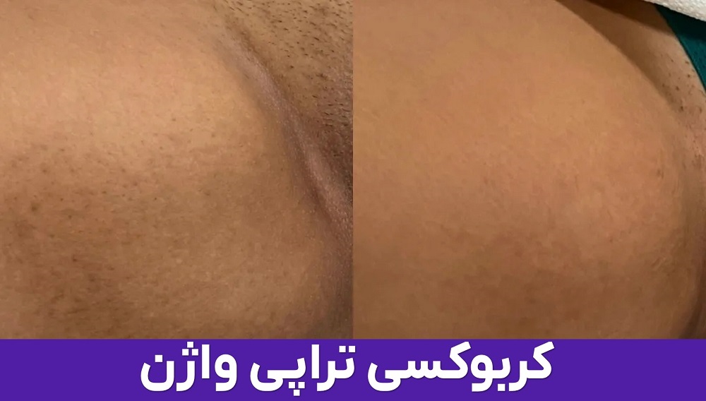 کربوکسی تراپی واژن افزایش گردش خون و بهبود ظاهر ناحیه تناسلی در کیمیا اکسیر