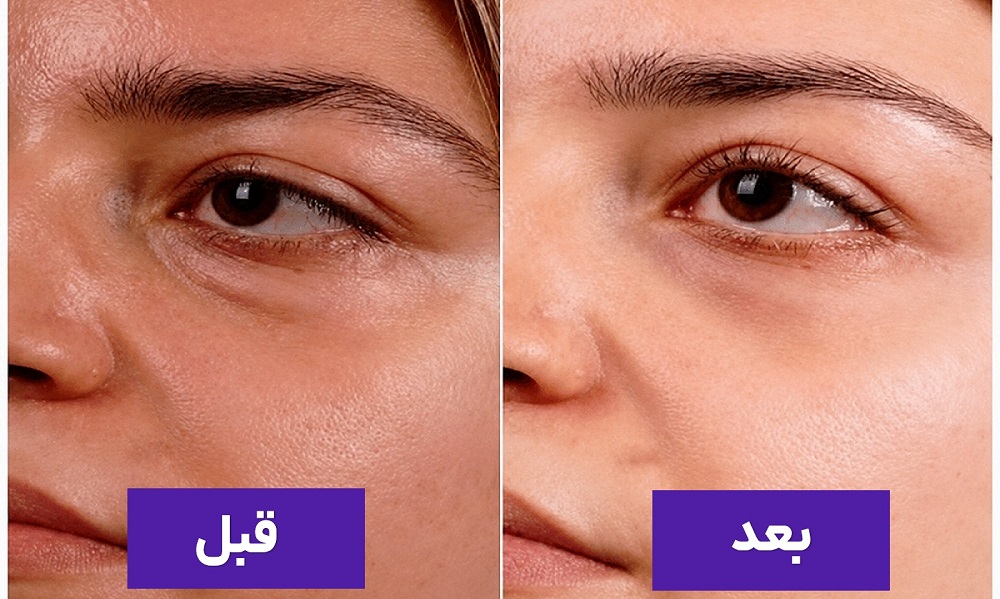 هزینه بلفاروپلاستی برای اصلاح پف زیر چشم و بهبود ظاهر چشم در کیمیا اکسیر