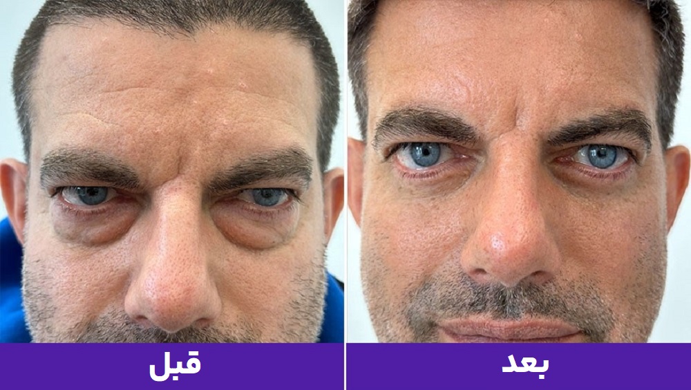 هزینه بلفاروپلاستی پلک پایین جهت رفع پف و چروک اطراف چشم و جوانسازی چهره در کیمیا اکسیر