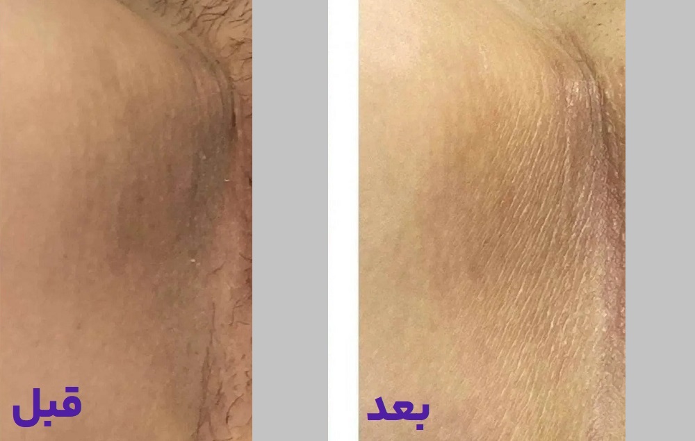 هزینه جوانسازی واژن در تهران