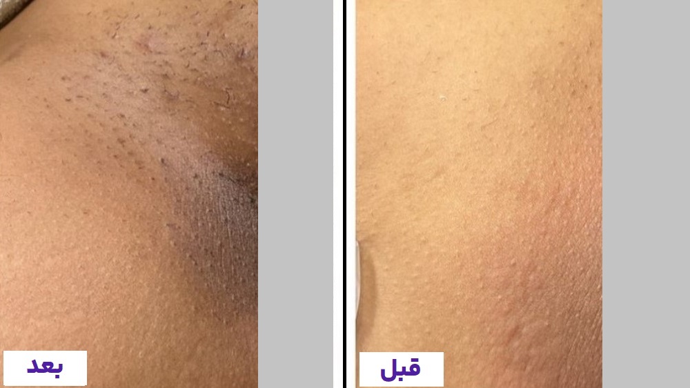 هزینه جوانسازی واژن برای بهبود افتادگی و افزایش شادابی ناحیه تناسلی در کیمیا اکسیر