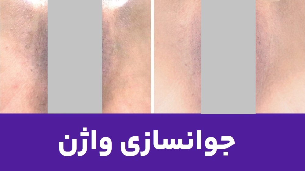 هزینه جوانسازی واژن در کلینیک زیبایی کیمیا اکسیر