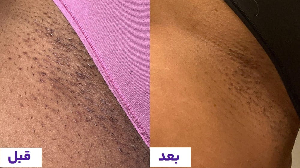 سفیدسازی واژن افزایش روشنایی پوست و یکنواختی رنگ ناحیه تناسلی در کیمیا اکسیر