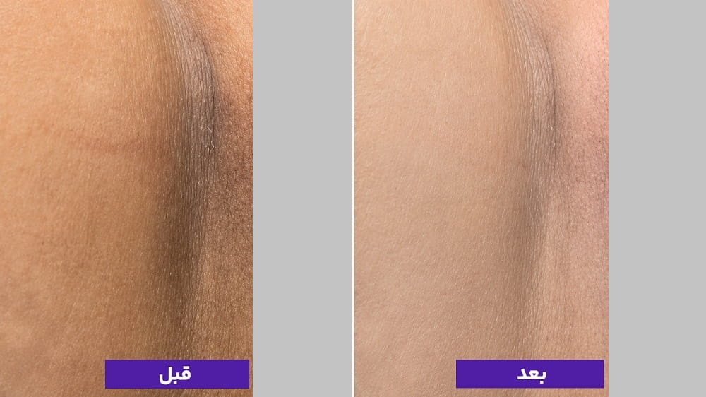 هزینه سفید سازی واژن در تهران