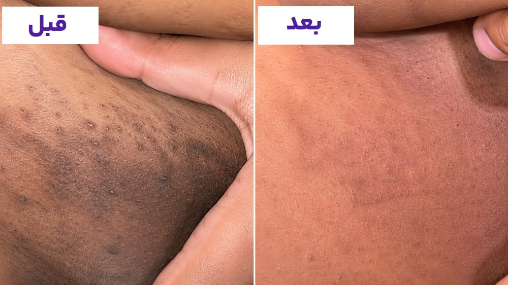 سفیدسازی واژن روشن_تر شدن پوست و افزایش زیبایی ناحیه تناسلی در کیمیا اکسیر